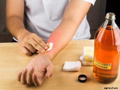 Getting Rid Of Pepper Burn – What Helps Hot Pepper Burn On Skin