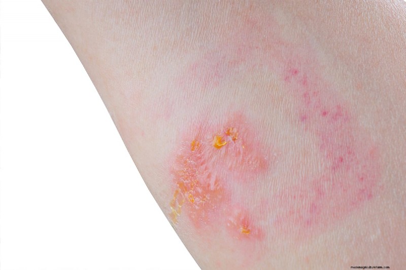 Does Poison Ivy Wither in Winter? Expert Guide to Identification, Treatment, and Safe Removal